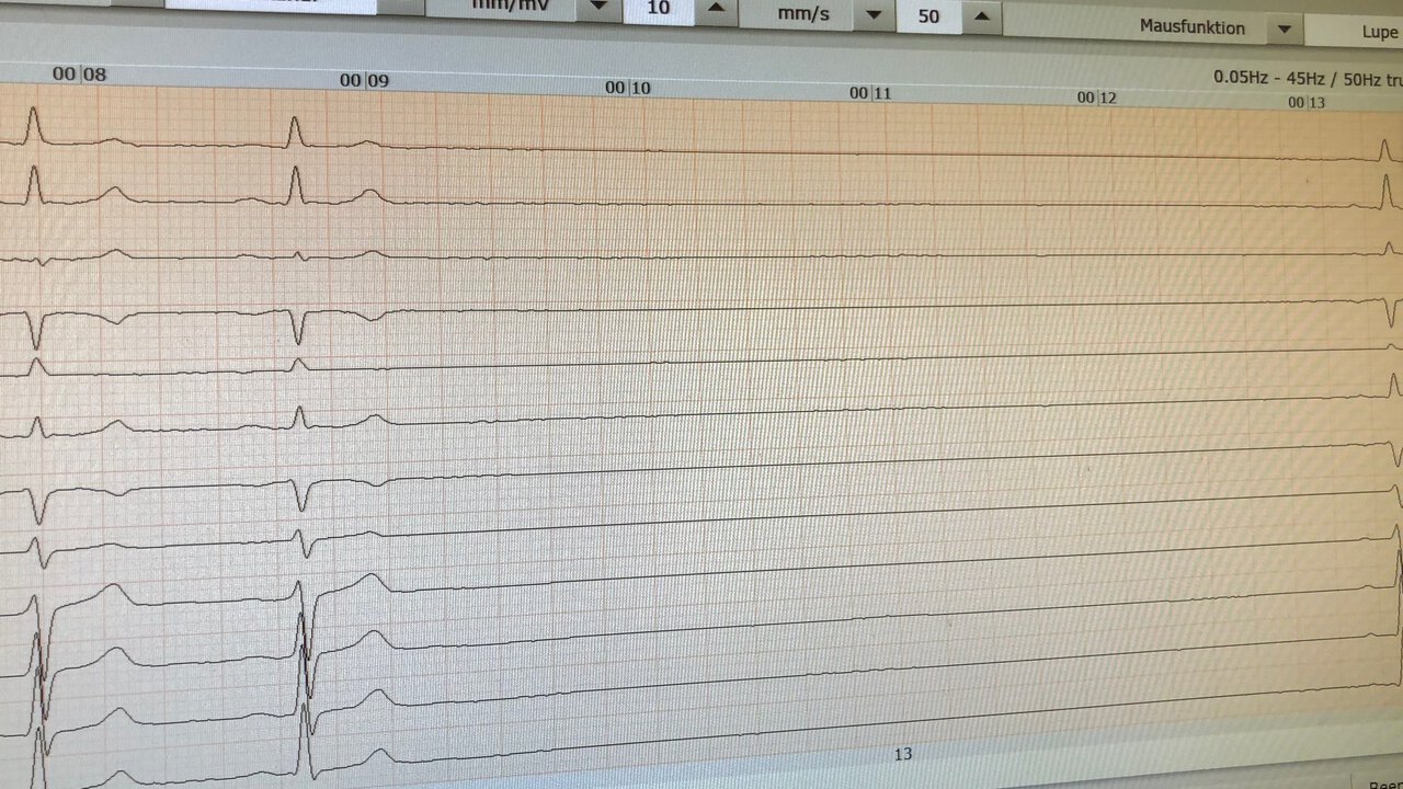 Aufzeichnung eines EKGs