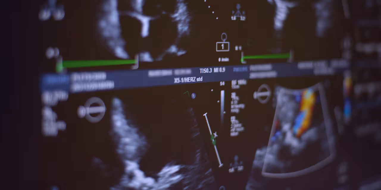 Echokardiogramm auf einem Monitor