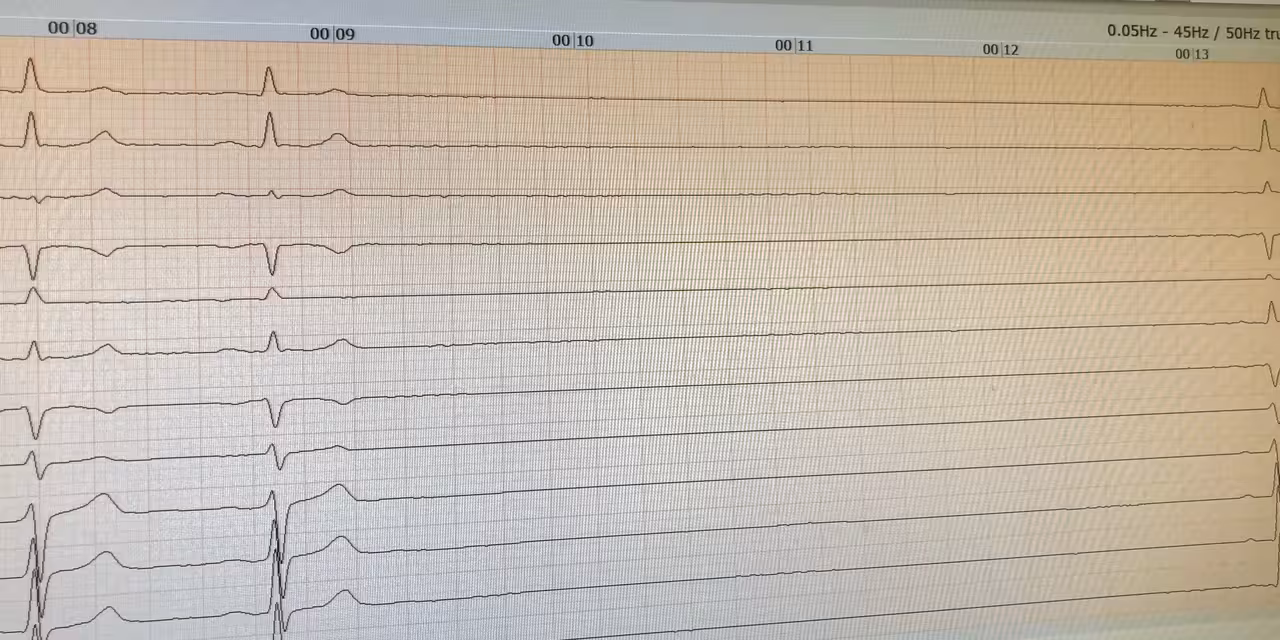 Aufzeichnung eines EKGs